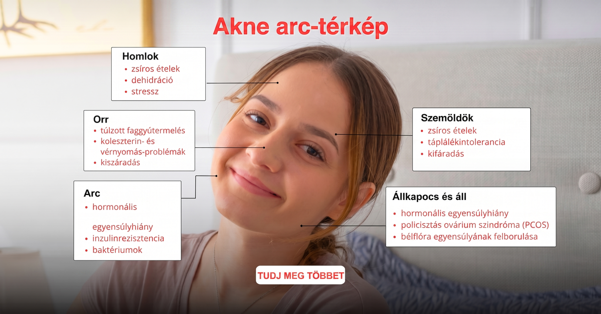 Akné arctérkép: pattanások az arc zónái szerint