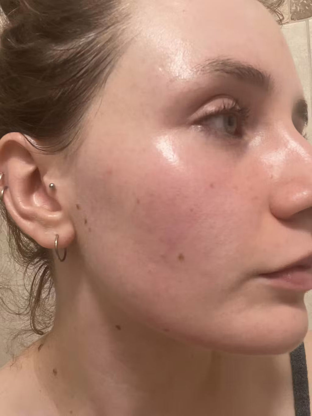 acne HU keep