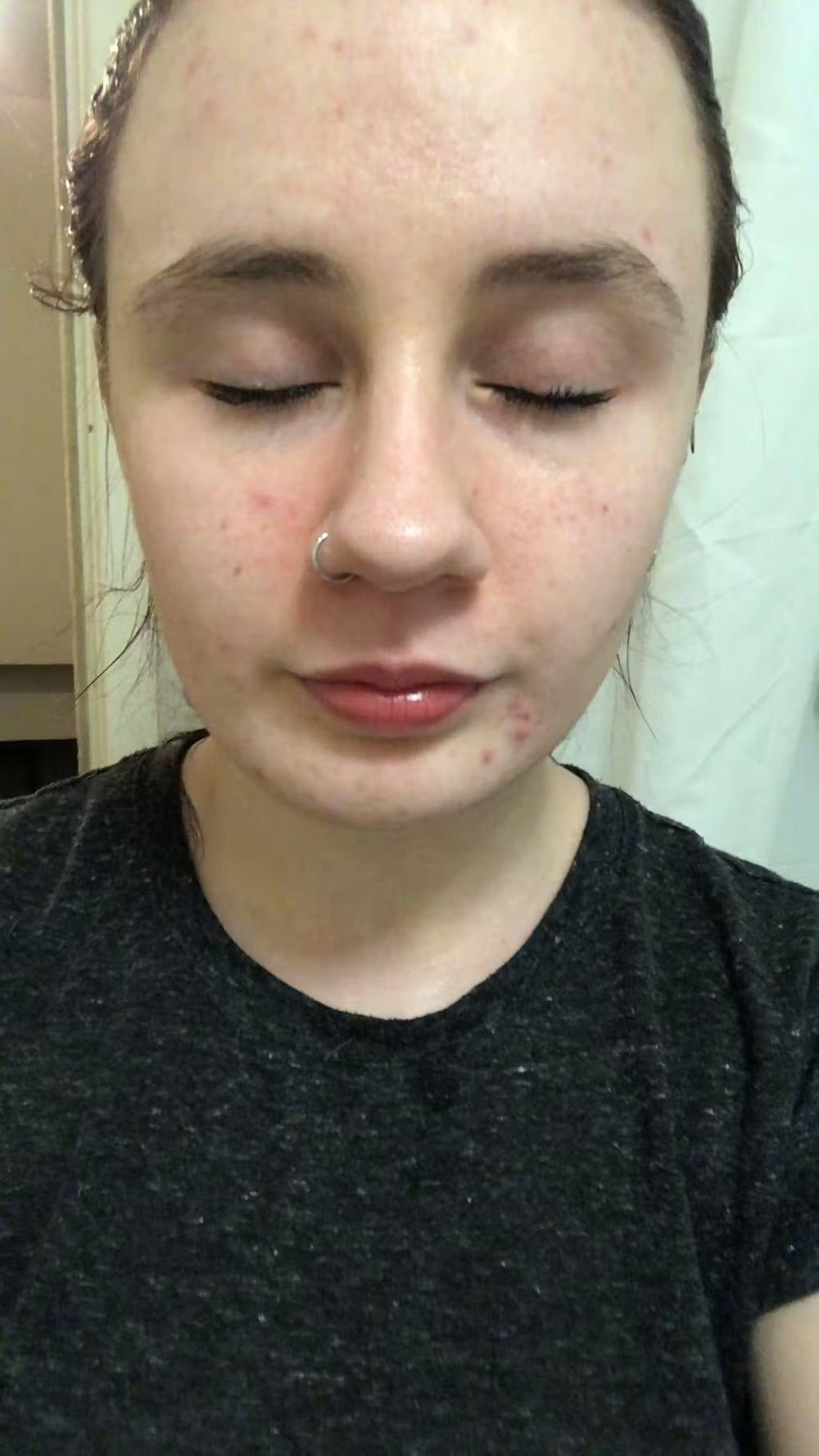 acne HU keep