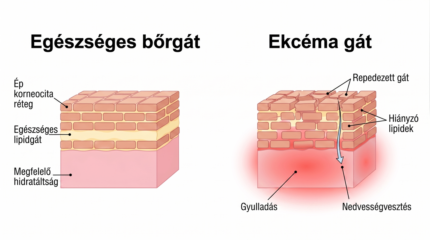 eczema_HU_skin_barrier_v2.png
