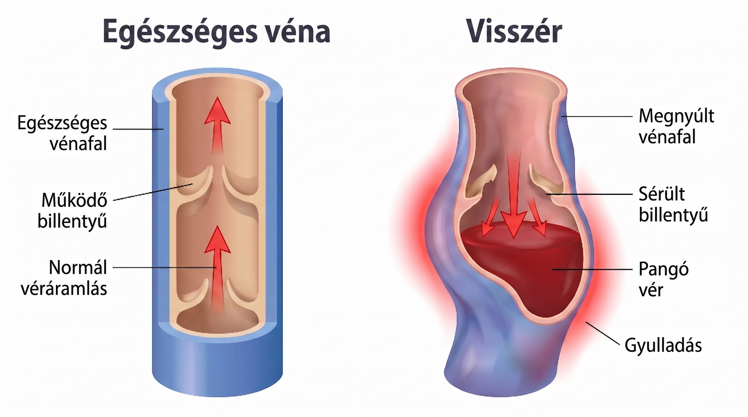 periodontis